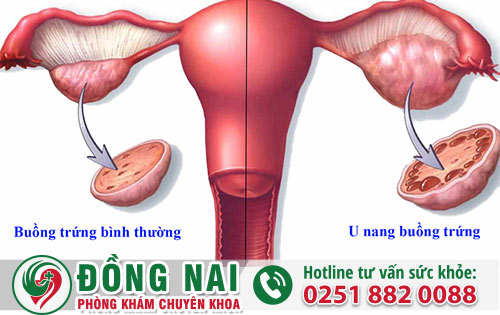 Bệnh u nang buồng trứng