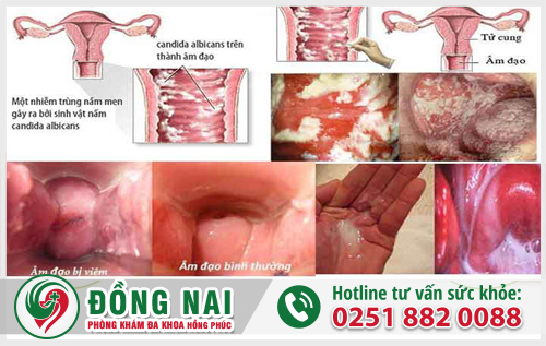 Hình ảnh nấm phụ khoa