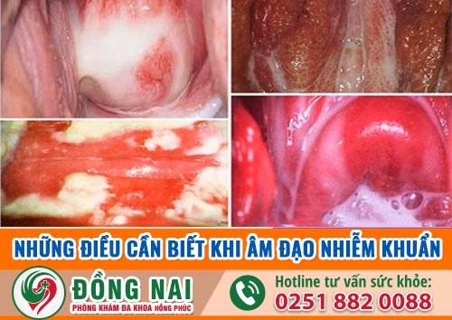 Triệu chứng của nhiễm khuẩn âm đạo